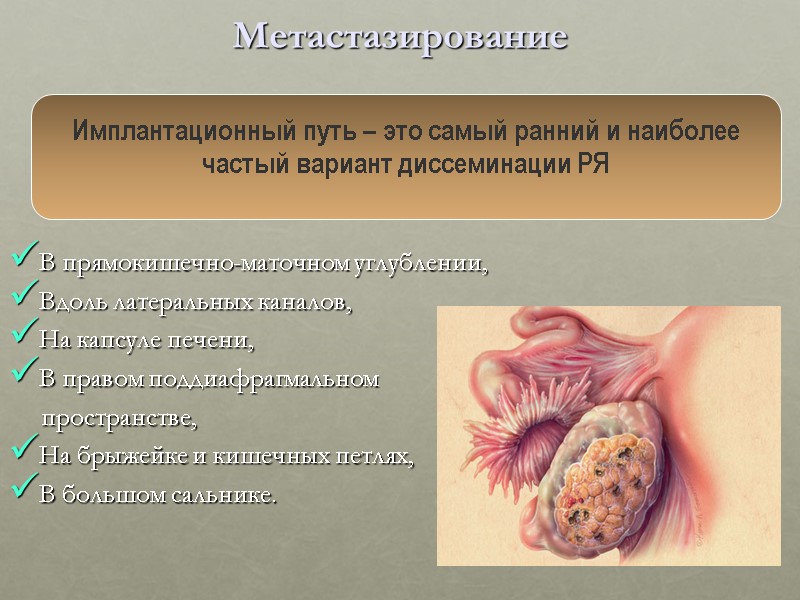 Метастазирование   В прямокишечно-маточном углублении, Вдоль латеральных каналов,  На капсуле печени, В
